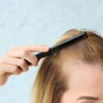 Alopecia Areata